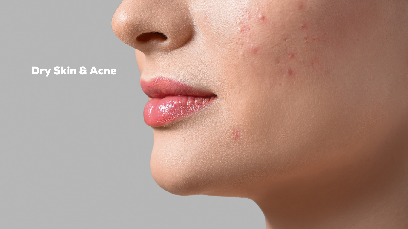 Dry Skin and Acne: Causes and Treatments